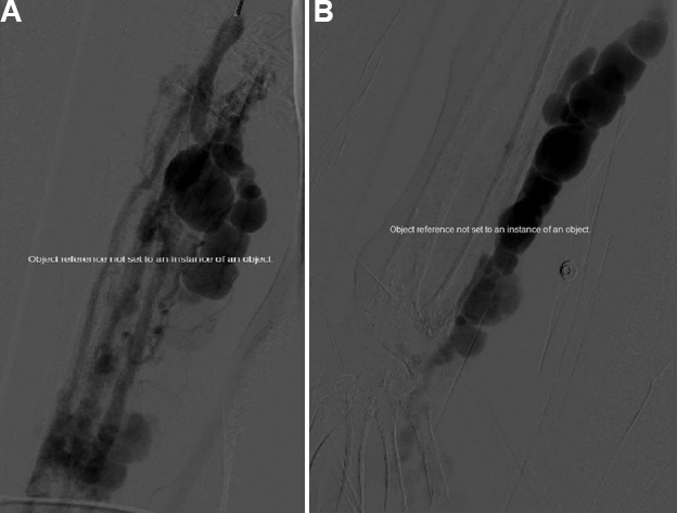 Digital subtraction angiogram (DSA). (A) Pre-embolization selective digital subtraction angiography of the right brachial artery showing a high-flow arteriovenous malformation (AVM) with feeders arising both from radial and ulnar arteries was noted, with early opacification of multiple dilated tortuous AVM. (B) Pre-embolization selective DSA of the right ulnar artery showing feeders arising from ulnar artery, opacification of the nidus of abnormal vessels and with extension into the hand.